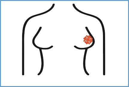 Homo sapiens / Breast Cancer